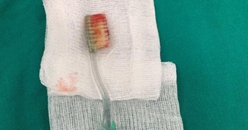 Nam thanh niên bị mắc kẹt bàn chải đánh răng trong thục quản vì lý do bất ngờ