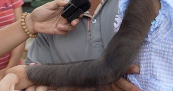 Kỳ lạ bé gái có “cánh tay khỉ”, da đen sì, mọc đầy lông