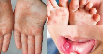 Dịch tay chân miệng bùng phát, xuất hiện chủng virus dễ gây bệnh nặng