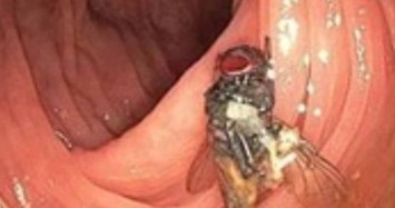 Bác sĩ phát hiện con ruồi còn nguyên vẹn khi nội soi đại tràng bệnh nhân