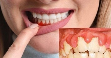 Đánh răng mỗi ngày nhưng không biết những điều này dễ khiến bạn gặp "trái đắng"