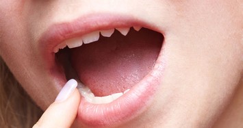 Nguy cơ bị ung thư lưỡi với 3 dấu hiệu bất thường ở miệng