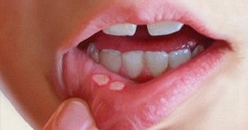Ung thư môi và những dấu hiệu nhận biết