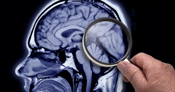 Hậu COVID-19: Nguy cơ tổn thương não lâu dài