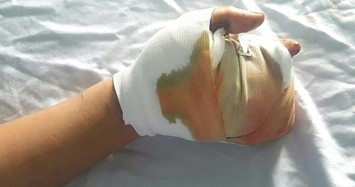 Đồng Nai: Nam thanh niên bị vỡ nát bàn tay do pháo nổ