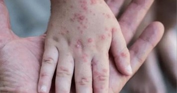 Đồng Nai: Xuất hiện ca mắc bệnh đậu mùa khỉ đầu tiên ở huyện Xuân Lộc