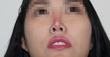 Những biến chứng phẫu thuật nâng mũi kinh hoàng, lòi cả sụn