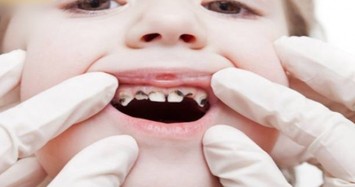 Thói quen tưởng tốt hóa ra khiến bé 3 tuổi sâu cả hàm răng 