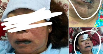 Một phụ nữ suýt mất mạng khi điều trị ở Bệnh viện Sài Gòn ITO