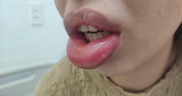 Tiêm môi, nâng ngực làm đẹp: Hậu quả khó lường khi tới các thẩm mỹ 'chui'
