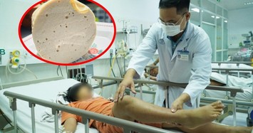  3 bệnh nhân ngộ độc giò lụa bị liệt hoàn toàn do không có thuốc giải độc 