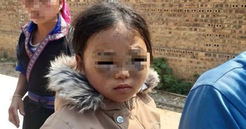 Hình ảnh thấy thương bé gái lớp 1 nghi bị cô giáo đánh bầm tím 2 mắt