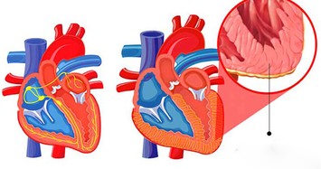 Những điều cần biết về bệnh viêm cơ tim sau 2 ca tử vong ở Hà Nội