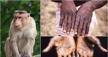 Video: Xem xét công bố tình trạng khẩn cấp toàn cầu về bệnh đậu mùa khỉ
