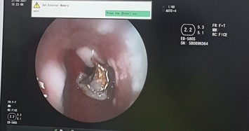 Người đàn ông bị 4 chiếc răng giả lọt vào phế quản khi ho