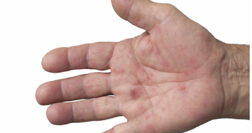 Dấu hiệu trên bàn tay có thể cảnh báo gan có vấn đề