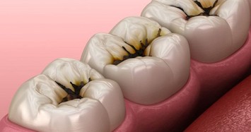 Những vấn đề sức khỏe khiến bạn hôi miệng dù đánh răng kỹ
