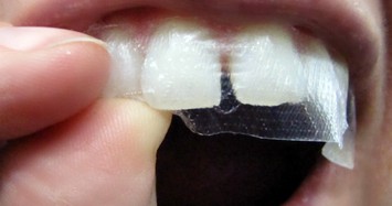 Những hậu quả khó lường khi sử dụng miếng dán trắng răng 