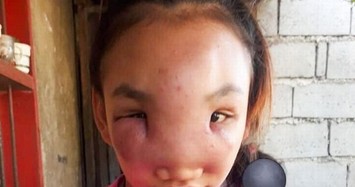 Kinh dị thiếu nữ 17 tuổi nguy cơ bị mù sau khi nặn mụn trên mũi
