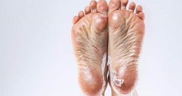 5 tín hiệu từ bàn chân cho thấy bạn cần đi khám gan ngay 