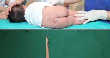 Phẫu thuật thành công cắt đuôi hiếm gặp cho bệnh nhi 5 tháng tuổi