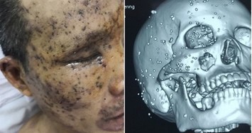 Nam công nhân bị vỡ nhãn cầu, 100 mảnh nhọn găm chi chít trên mặt