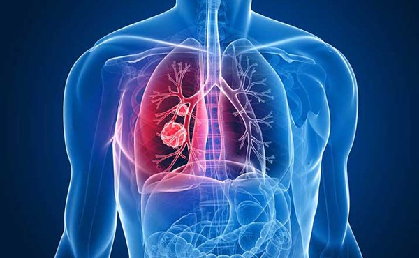 Dấu hiệu bất thường ở chân cảnh báo ung thư phổi 