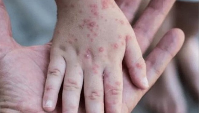 Đồng Nai: Xuất hiện ca mắc bệnh đậu mùa khỉ đầu tiên ở huyện Xuân Lộc