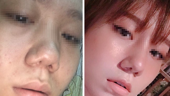 Cô gái tố bị hỏng mũi, trầm cảm sau khi nâng mũi tại thẩm mỹ viện Klain Beauty Center