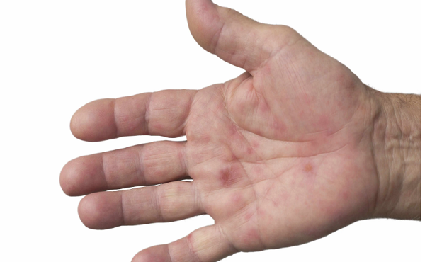 Dấu hiệu trên bàn tay có thể cảnh báo gan có vấn đề