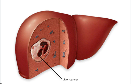 3 dấu hiệu ung thư gan dễ bị bỏ qua