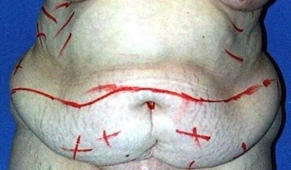 Bà mẹ béo phì được phẫu thuật cắt 7kg da, mỡ thừa 