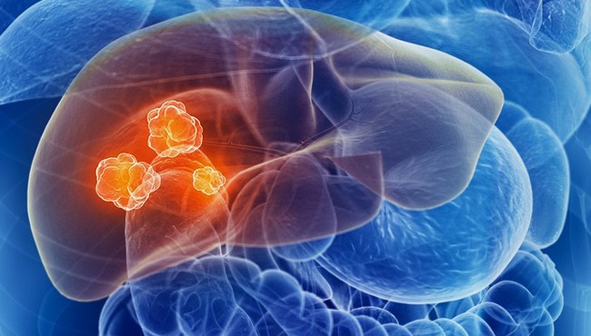 3 loại nguyên liệu làm tổn thương gan, nuôi tế bào ung thư
