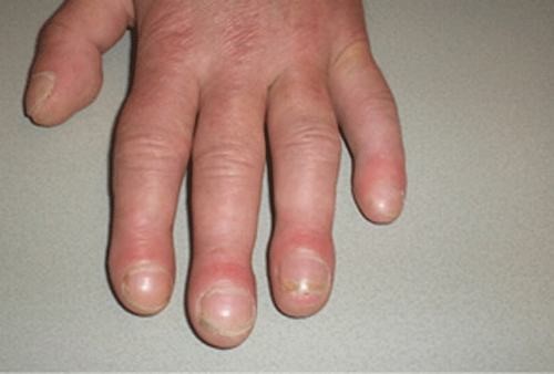 3 dấu hiệu xuất hiện ở bàn tay có nguy cơ bị bệnh phổi