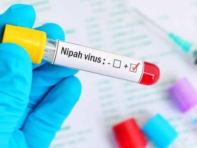 Virus Nipah bung phat, ty le tu vong toi 75%